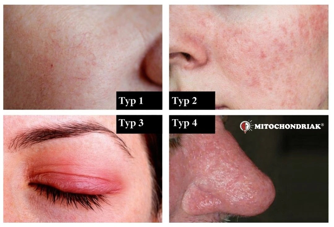 rosacea-types